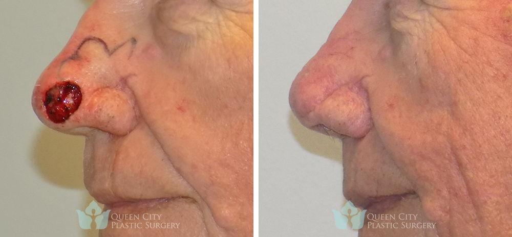 Real Patient of Dr. Enam Haque of Queen City Plastic Surgery in Charlotte, NC