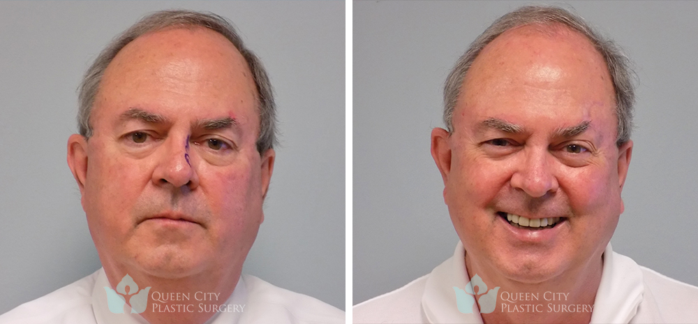 Real Patient of Dr. Enam Haque of Queen City Plastic Surgery in Charlotte, NC