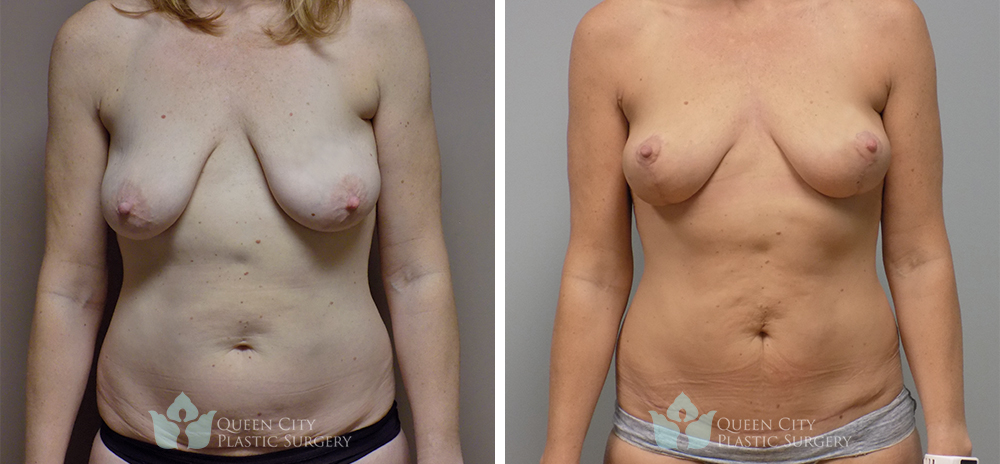 Real Patient of Dr. Enam Haque of Queen City Plastic Surgery in Charlotte, NC