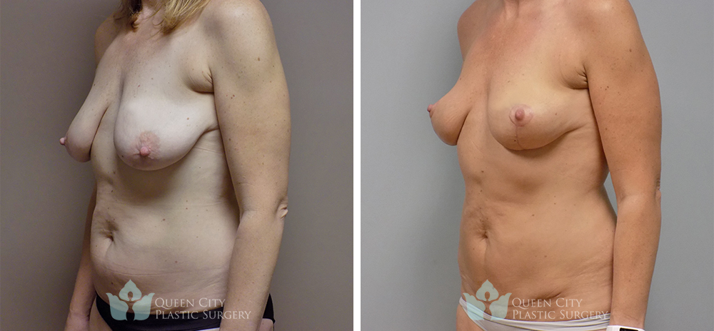 Real Patient of Dr. Enam Haque of Queen City Plastic Surgery in Charlotte, NC