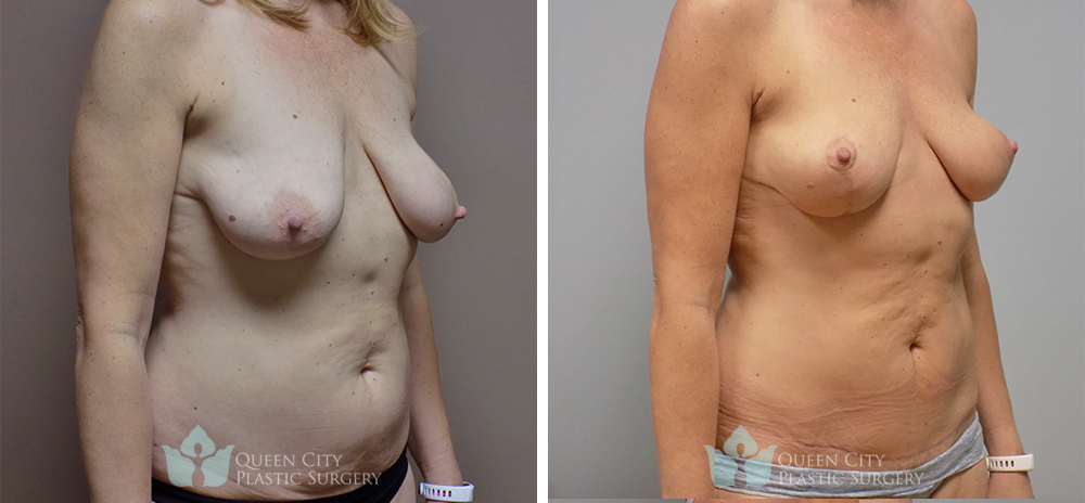 Real Patient of Dr. Enam Haque of Queen City Plastic Surgery in Charlotte, NC