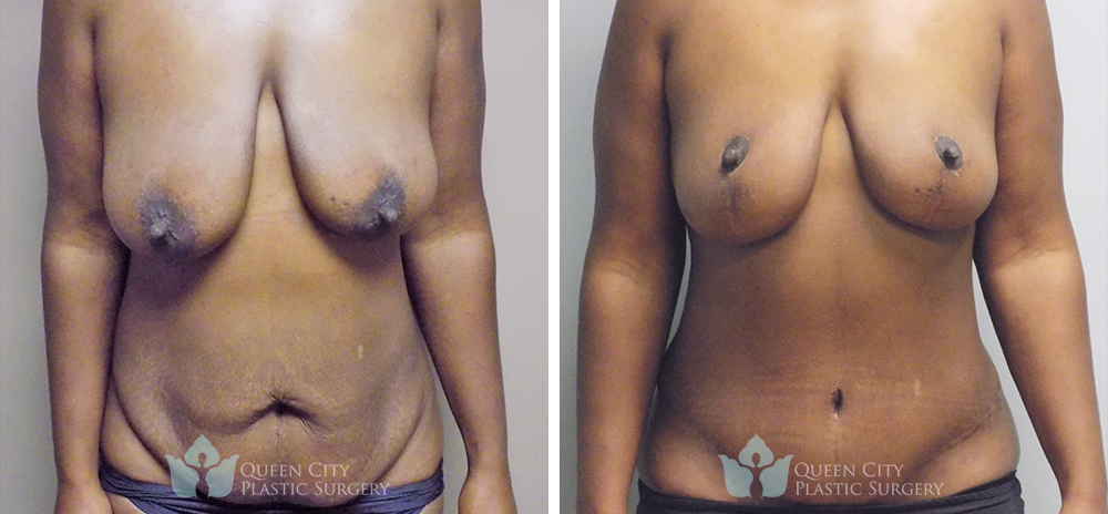 Real Patient of Dr. Enam Haque of Queen City Plastic Surgery in Charlotte, NC