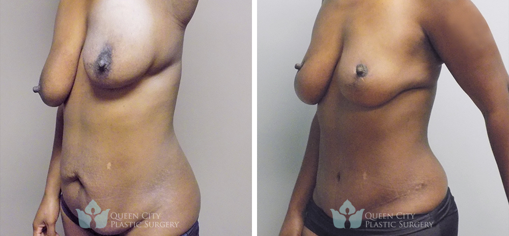 Real Patient of Dr. Enam Haque of Queen City Plastic Surgery in Charlotte, NC