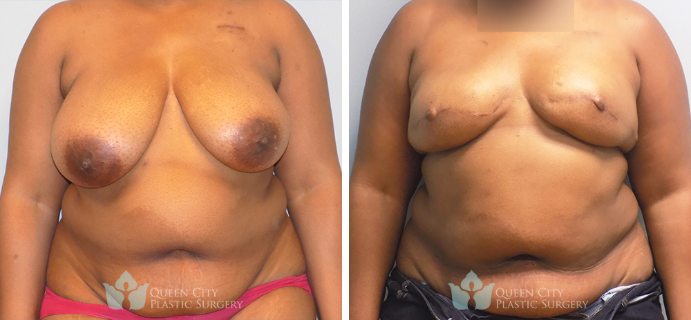 Real Patient of Dr. Enam Haque of Queen City Plastic Surgery in Charlotte, NC