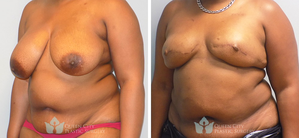 Real Patient of Dr. Enam Haque of Queen City Plastic Surgery in Charlotte, NC