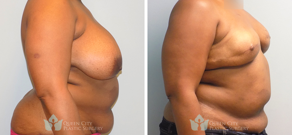 Real Patient of Dr. Enam Haque of Queen City Plastic Surgery in Charlotte, NC