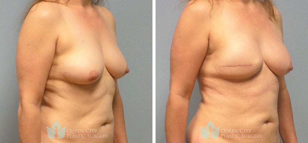 Real Patient of Dr. Enam Haque of Queen City Plastic Surgery in Charlotte, NC