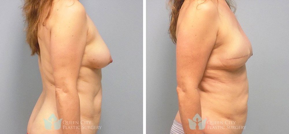 Real Patient of Dr. Enam Haque of Queen City Plastic Surgery in Charlotte, NC