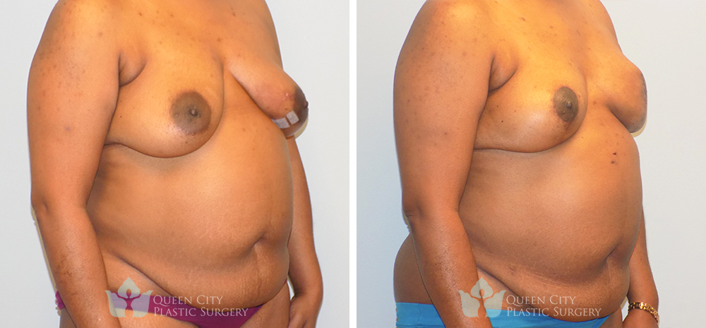 Real Patient of Dr. Enam Haque of Queen City Plastic Surgery in Charlotte, NC