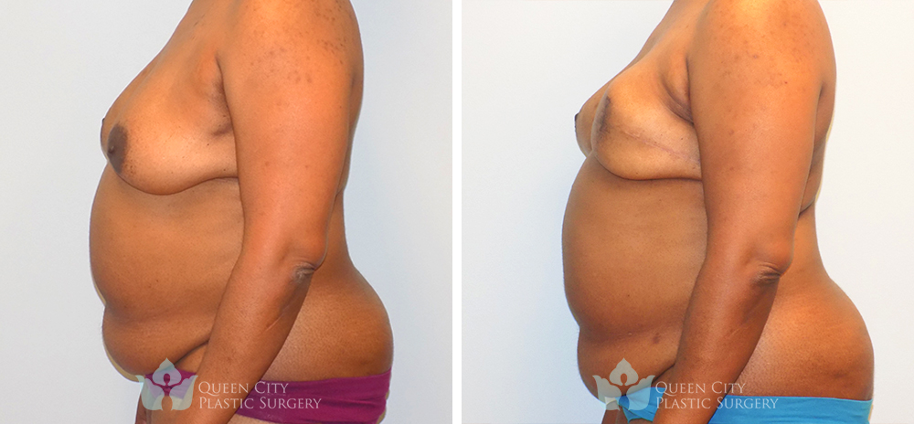 Real Patient of Dr. Enam Haque of Queen City Plastic Surgery in Charlotte, NC