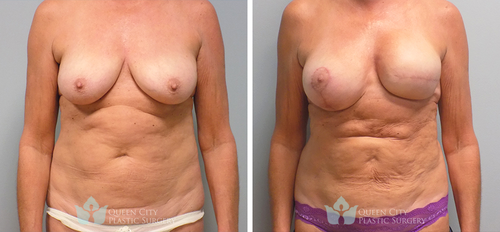 Real Patient of Dr. Enam Haque of Queen City Plastic Surgery in Charlotte, NC