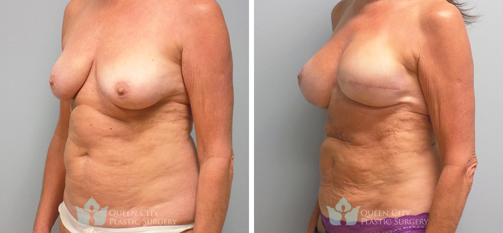 Real Patient of Dr. Enam Haque of Queen City Plastic Surgery in Charlotte, NC