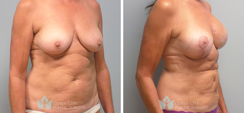 Real Patient of Dr. Enam Haque of Queen City Plastic Surgery in Charlotte, NC