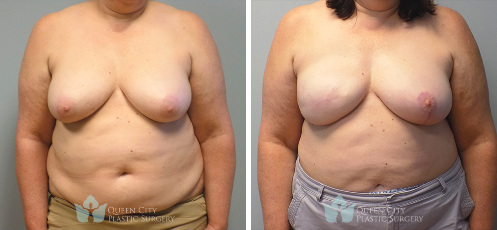 Real Patient of Dr. Enam Haque of Queen City Plastic Surgery in Charlotte, NC