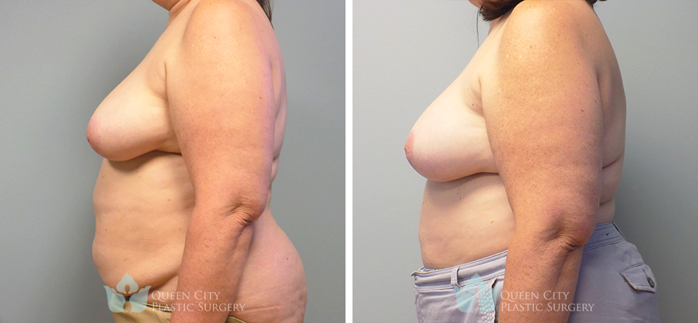 Real Patient of Dr. Enam Haque of Queen City Plastic Surgery in Charlotte, NC