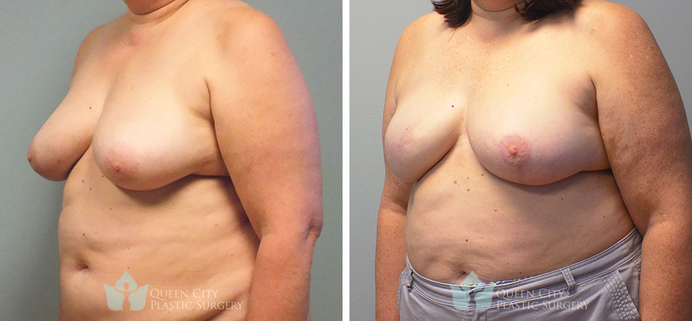 Real Patient of Dr. Enam Haque of Queen City Plastic Surgery in Charlotte, NC