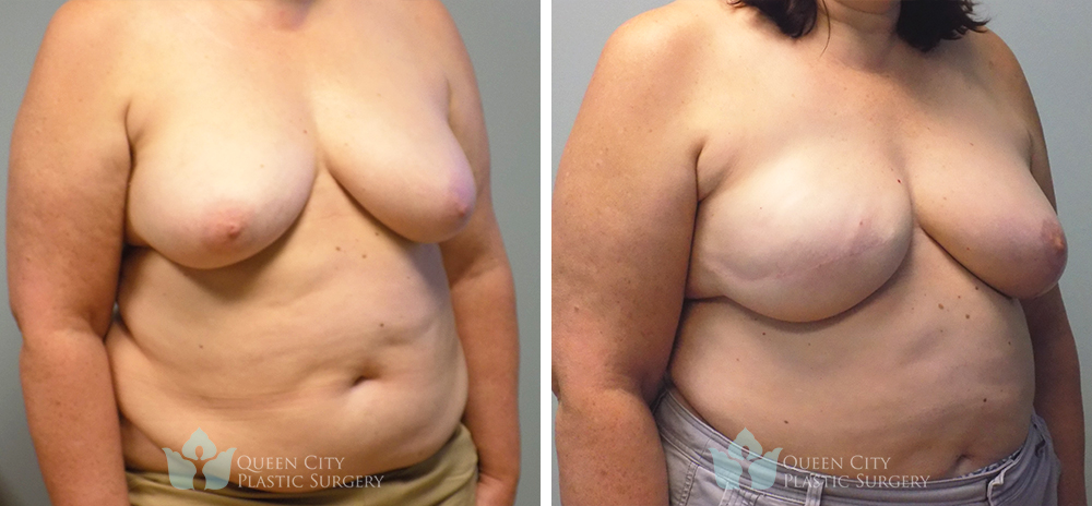 Real Patient of Dr. Enam Haque of Queen City Plastic Surgery in Charlotte, NC