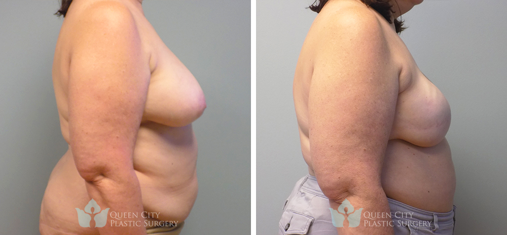 Real Patient of Dr. Enam Haque of Queen City Plastic Surgery in Charlotte, NC