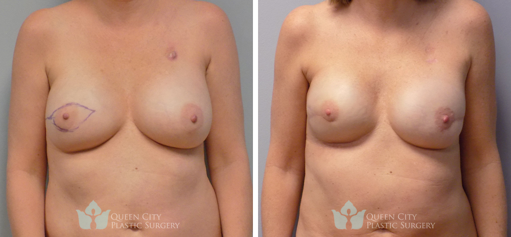 Real Patient of Dr. Enam Haque of Queen City Plastic Surgery in Charlotte, NC