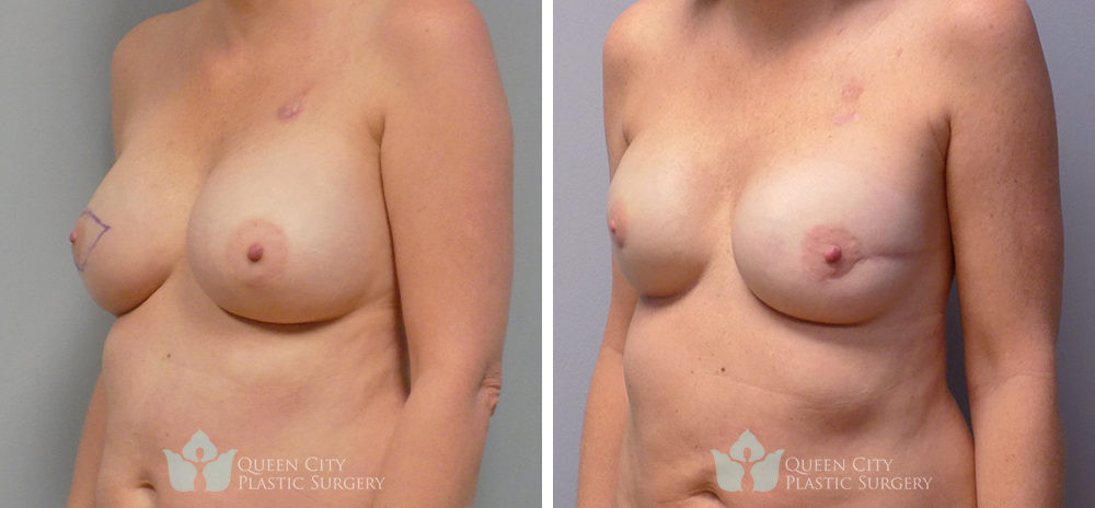 Real Patient of Dr. Enam Haque of Queen City Plastic Surgery in Charlotte, NC