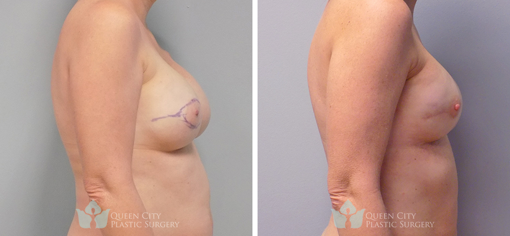 Real Patient of Dr. Enam Haque of Queen City Plastic Surgery in Charlotte, NC