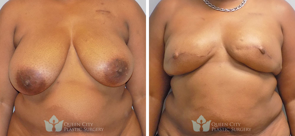 Real Patient of Dr. Enam Haque of Queen City Plastic Surgery in Charlotte, NC