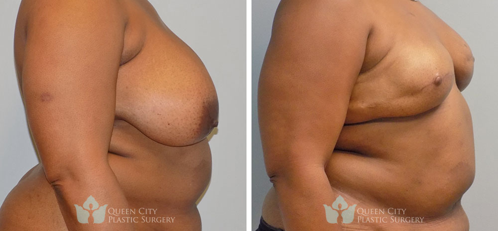 Real Patient of Dr. Enam Haque of Queen City Plastic Surgery in Charlotte, NC