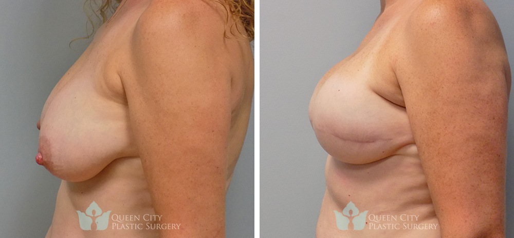 Real Patient of Dr. Enam Haque of Queen City Plastic Surgery in Charlotte, NC