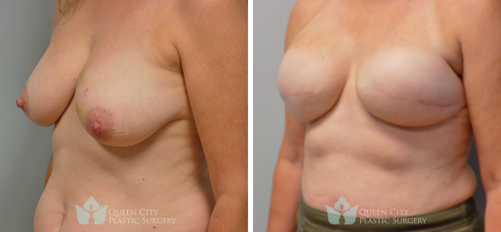 Real Patient of Dr. Enam Haque of Queen City Plastic Surgery in Charlotte, NC