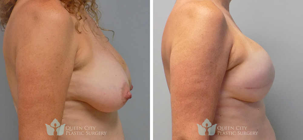 Real Patient of Dr. Enam Haque of Queen City Plastic Surgery in Charlotte, NC