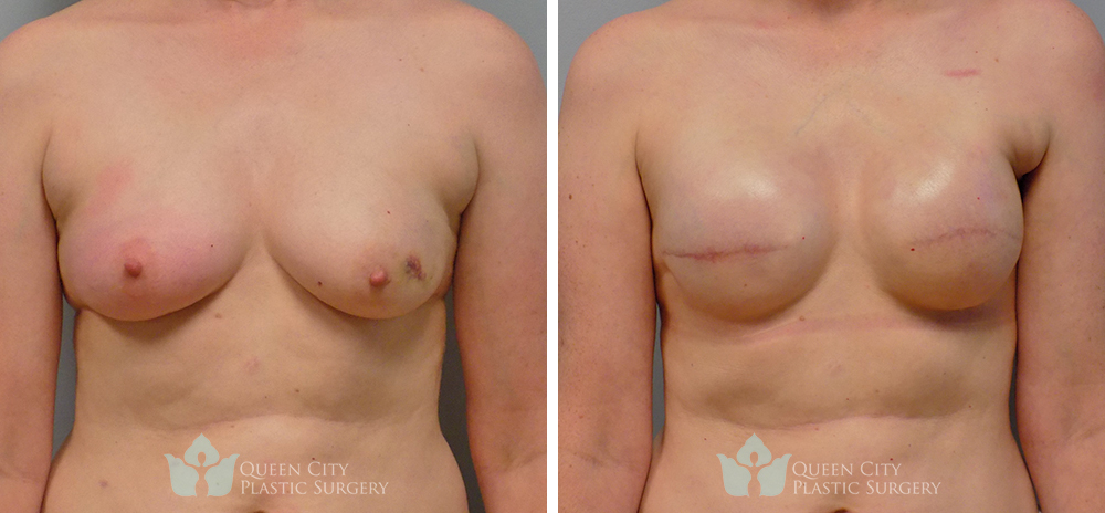 Real Patient of Dr. Enam Haque of Queen City Plastic Surgery in Charlotte, NC