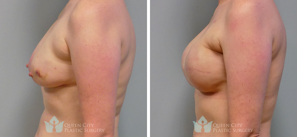 Real Patient of Dr. Enam Haque of Queen City Plastic Surgery in Charlotte, NC