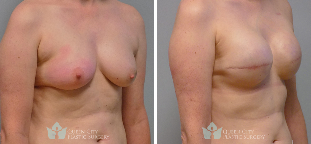 Real Patient of Dr. Enam Haque of Queen City Plastic Surgery in Charlotte, NC