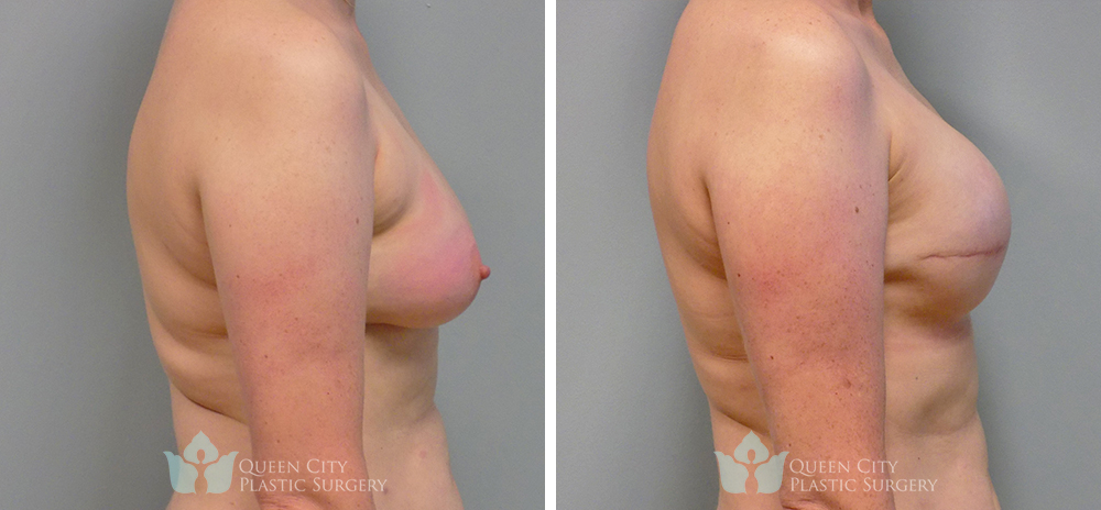 Real Patient of Dr. Enam Haque of Queen City Plastic Surgery in Charlotte, NC