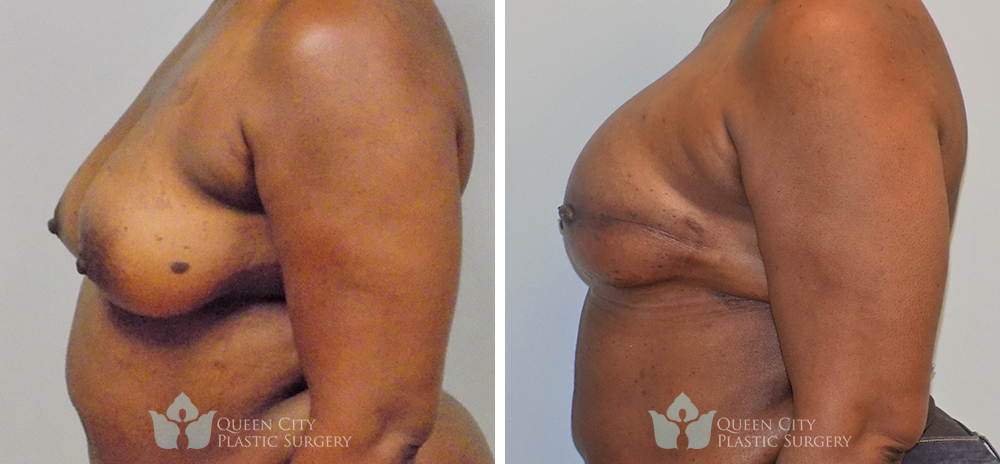 Real Patient of Dr. Enam Haque of Queen City Plastic Surgery in Charlotte, NC