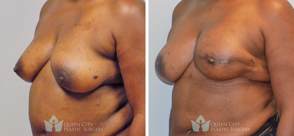 Real Patient of Dr. Enam Haque of Queen City Plastic Surgery in Charlotte, NC