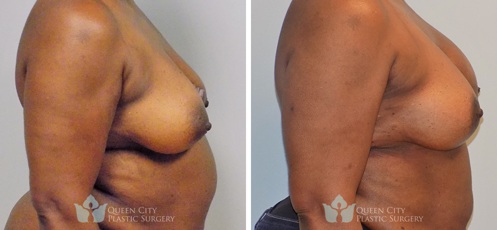 Real Patient of Dr. Enam Haque of Queen City Plastic Surgery in Charlotte, NC