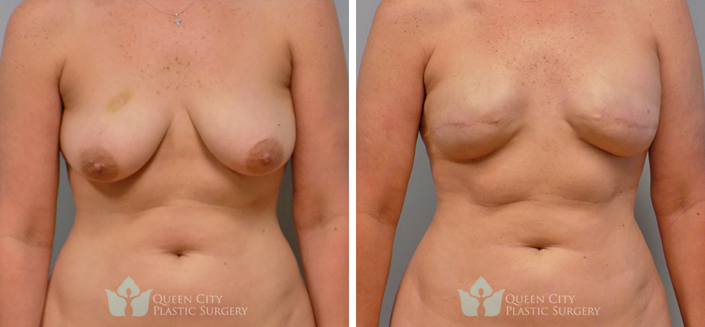 Real Patient of Dr. Enam Haque of Queen City Plastic Surgery in Charlotte, NC