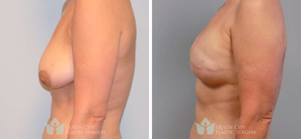 Real Patient of Dr. Enam Haque of Queen City Plastic Surgery in Charlotte, NC