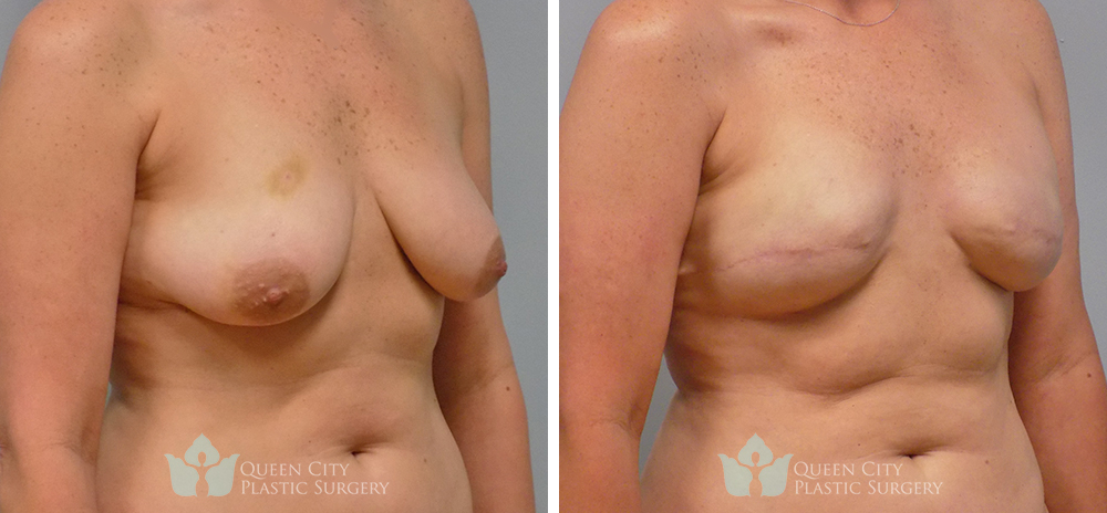 Real Patient of Dr. Enam Haque of Queen City Plastic Surgery in Charlotte, NC