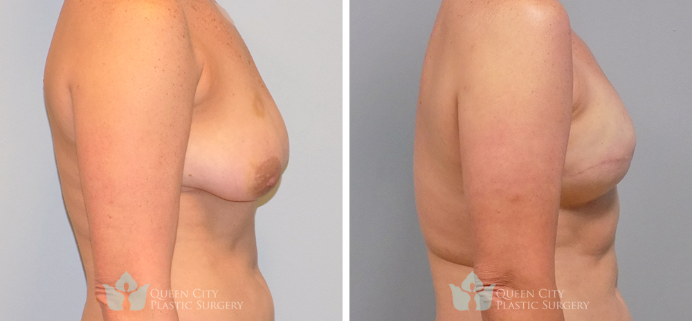 Real Patient of Dr. Enam Haque of Queen City Plastic Surgery in Charlotte, NC