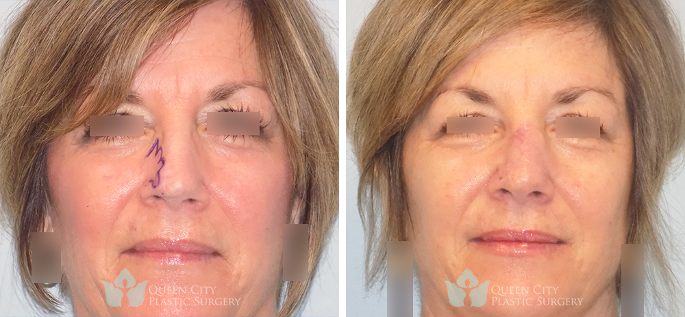 Real Patient of Dr. Enam Haque of Queen City Plastic Surgery in Charlotte, NC