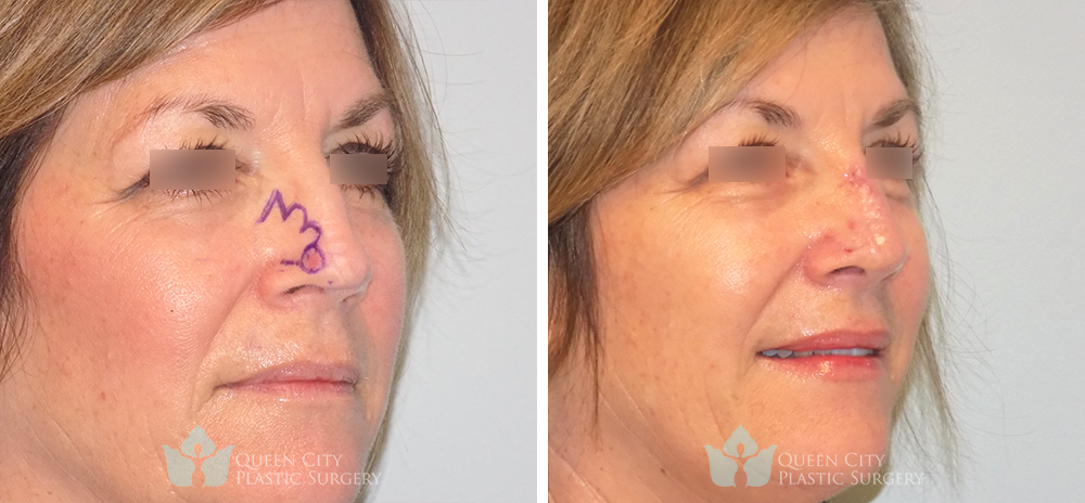 Real Patient of Dr. Enam Haque of Queen City Plastic Surgery in Charlotte, NC