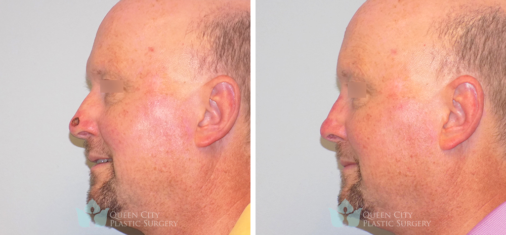 Real Patient of Dr. Enam Haque of Queen City Plastic Surgery in Charlotte, NC