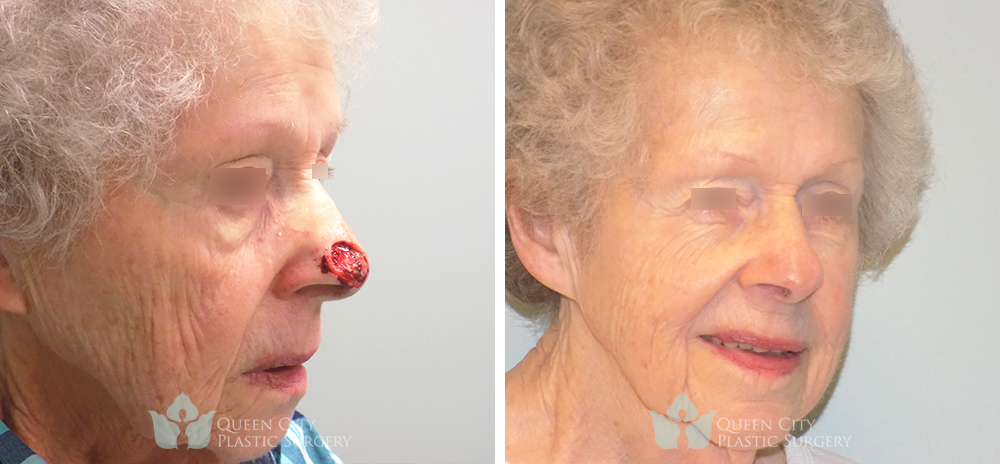 Real Patient of Dr. Enam Haque of Queen City Plastic Surgery in Charlotte, NC