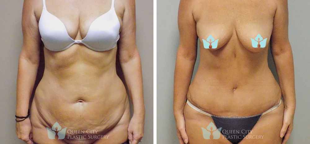 Real Patient of Dr. Enam Haque of Queen City Plastic Surgery in Charlotte, NC