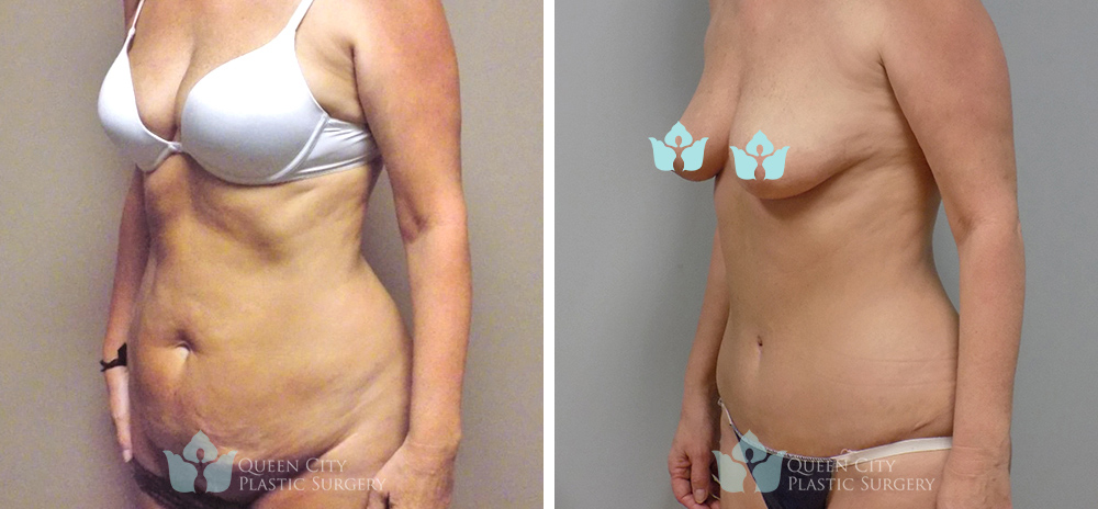 Real Patient of Dr. Enam Haque of Queen City Plastic Surgery in Charlotte, NC