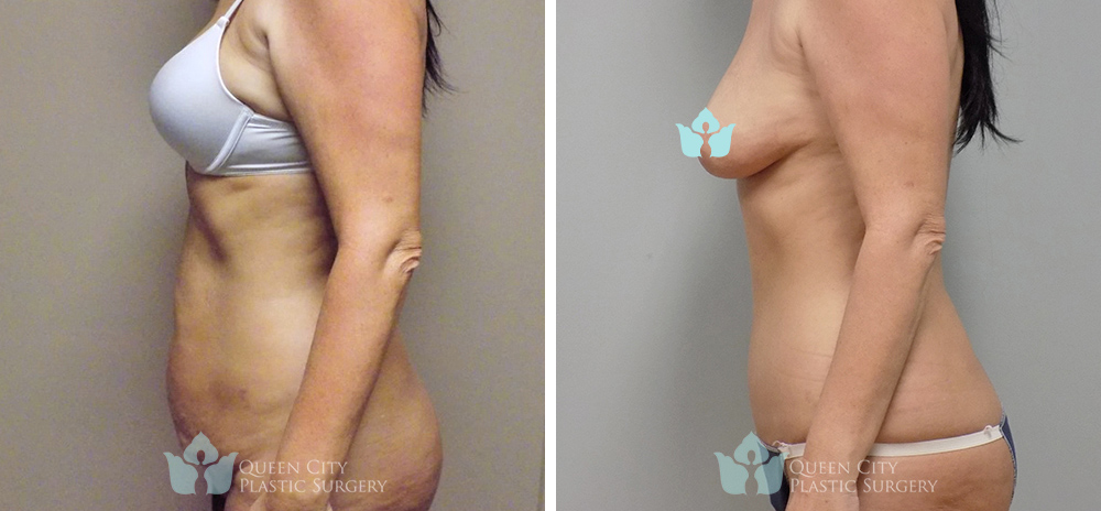 Real Patient of Dr. Enam Haque of Queen City Plastic Surgery in Charlotte, NC