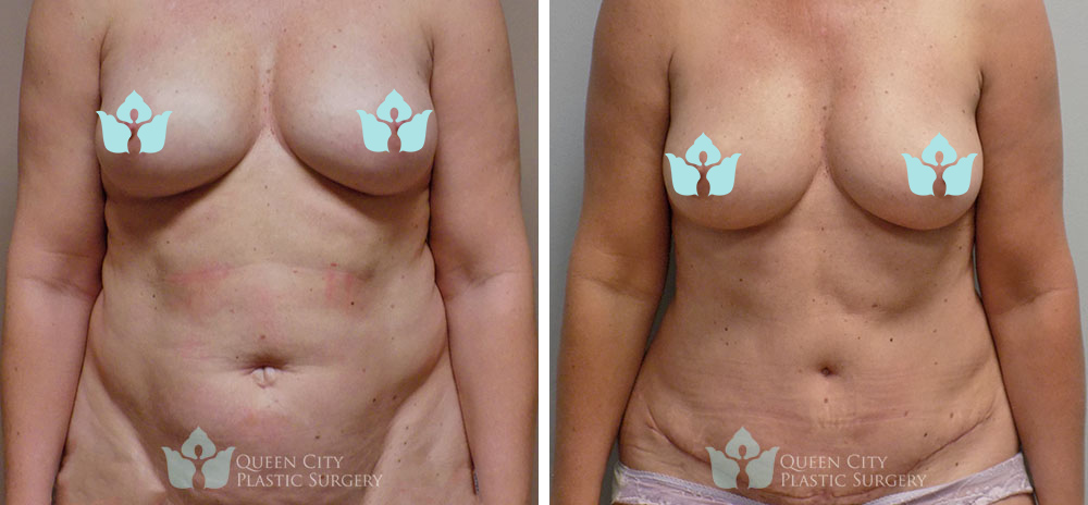 Real Patient of Dr. Enam Haque of Queen City Plastic Surgery in Charlotte, NC