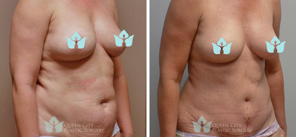 Real Patient of Dr. Enam Haque of Queen City Plastic Surgery in Charlotte, NC